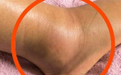 If You Notice Your Legs Are Swollen, Doctors Warn It Could Be a Sign of part 2